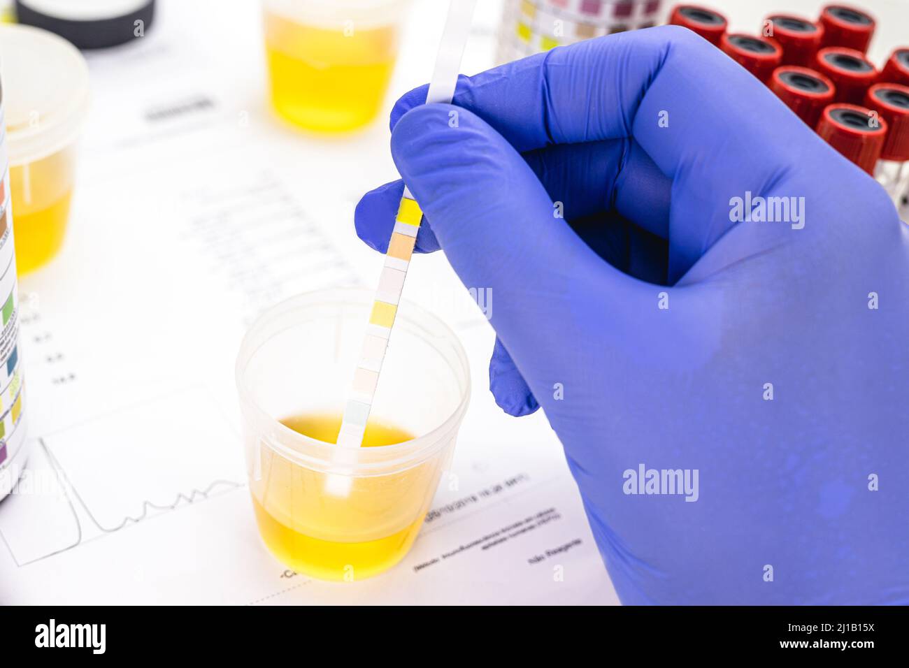 urinalysis with reagent strips to analyze Leukocytes, Urobilinogen