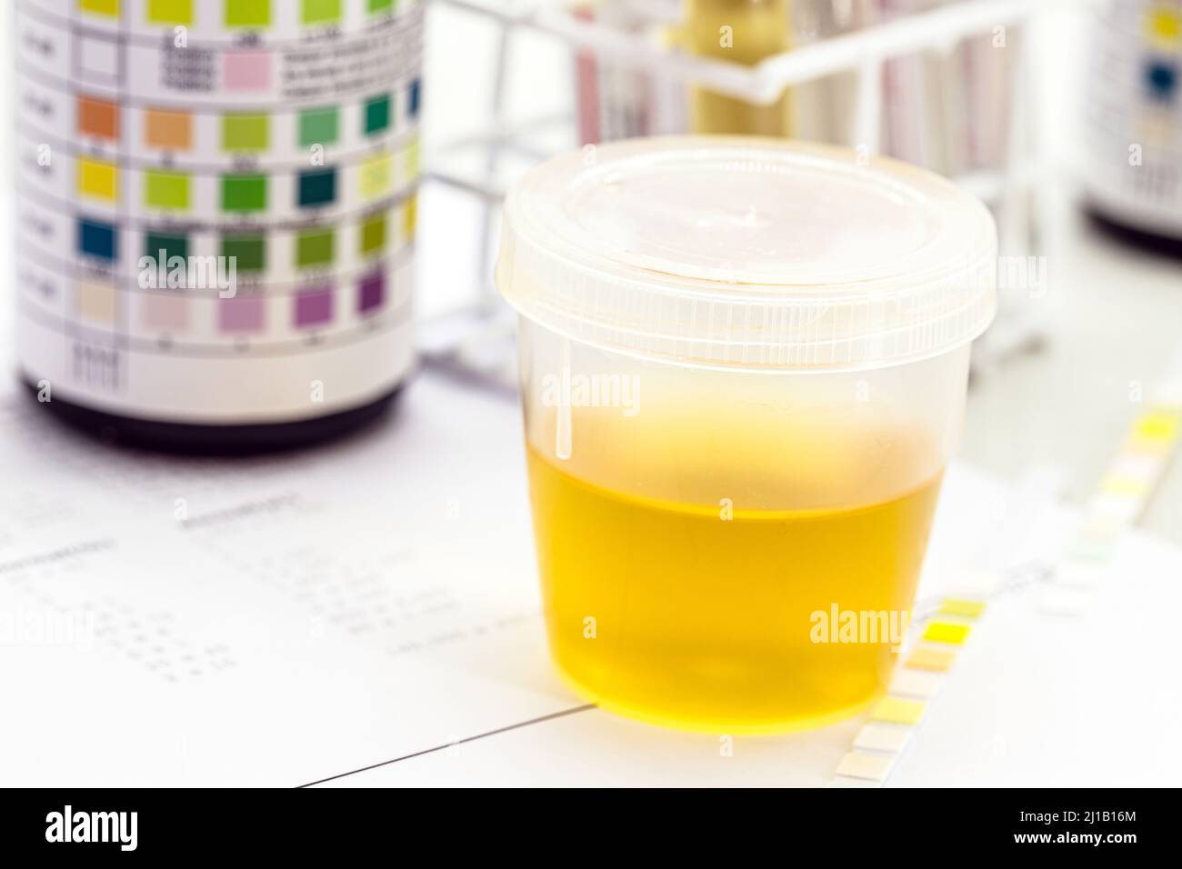 urine bottle, urinalysis to analyze Leukocytes, Urobilinogen, Bilirubin