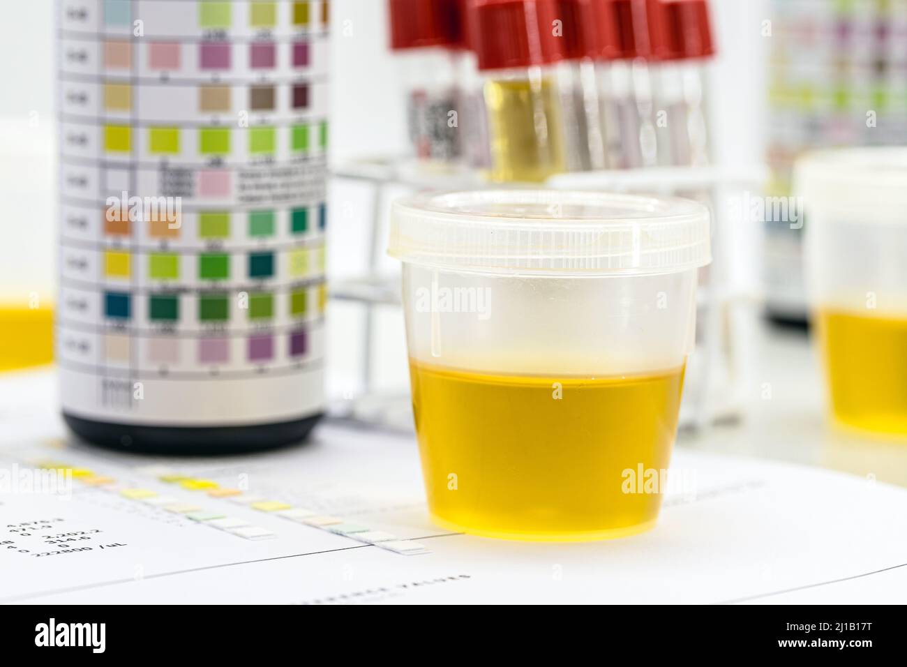 urine bottle, urinalysis to analyze Leukocytes, Urobilinogen, Bilirubin