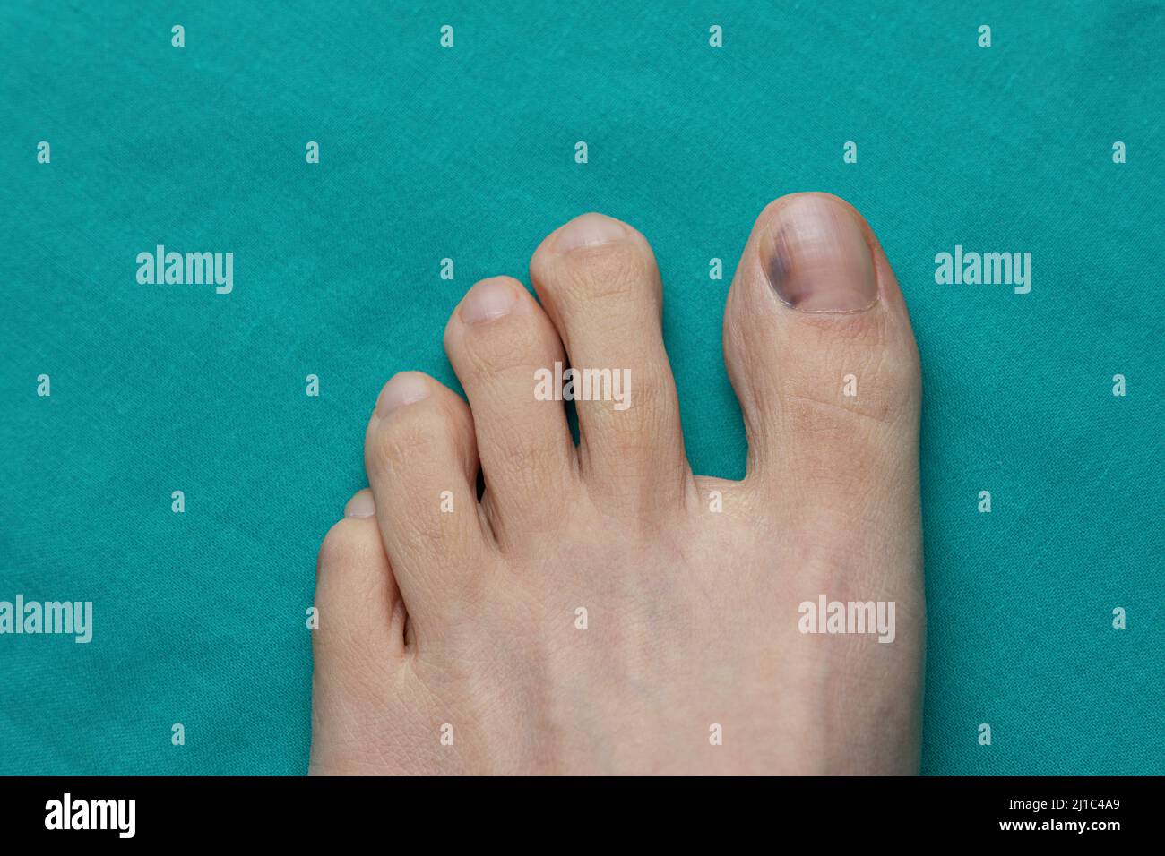 Nail bruise on green background. Medicine concept Stock Photo Alamy