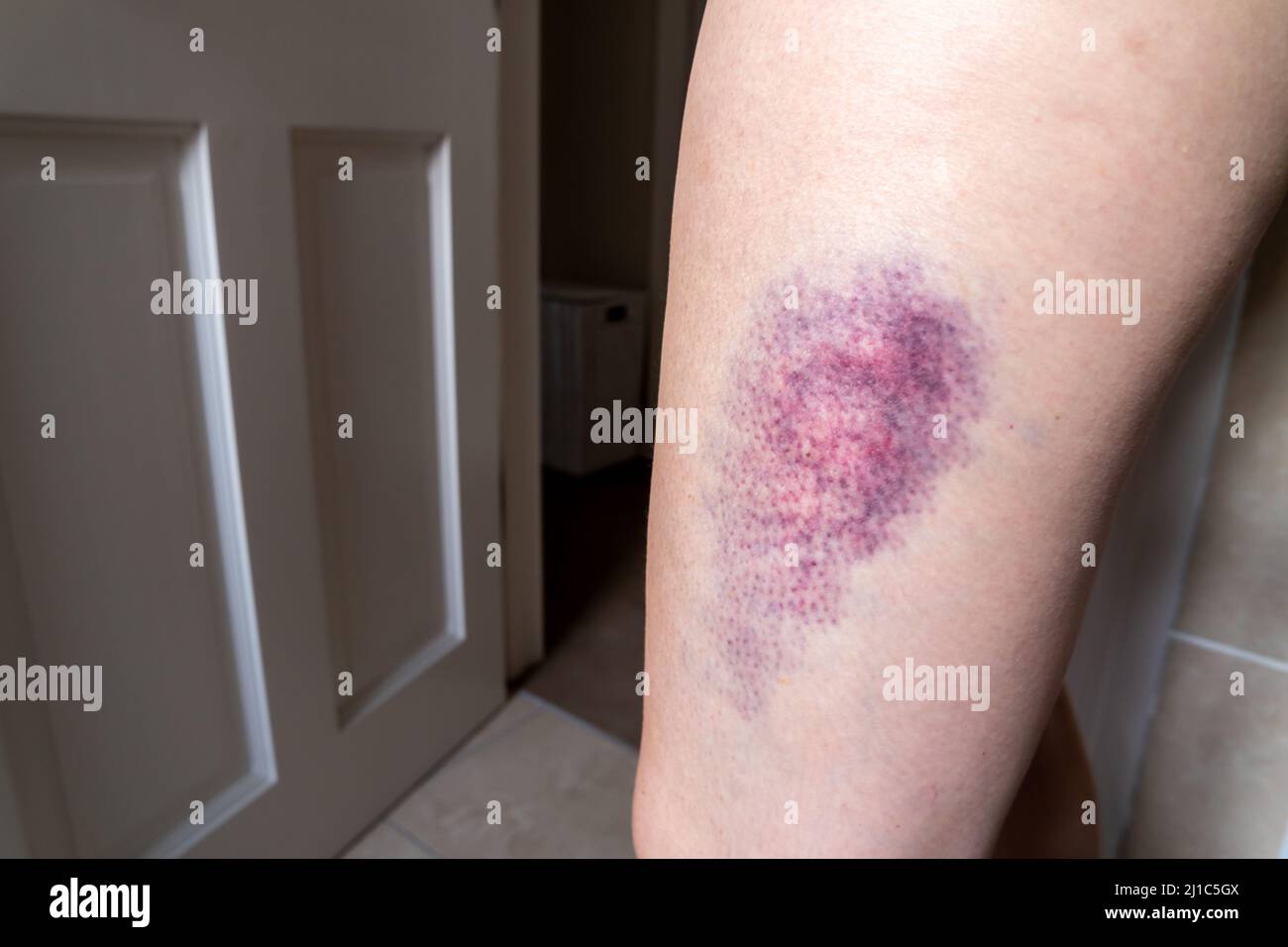 Terrible bruise on the upper leg of a woman. Stock Photo