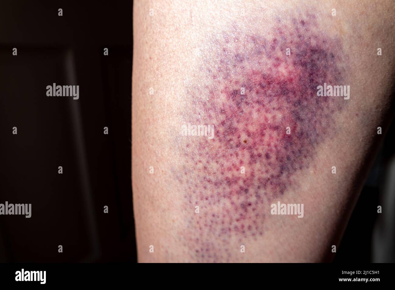 Terrible bruise on the upper leg of a woman. Stock Photo