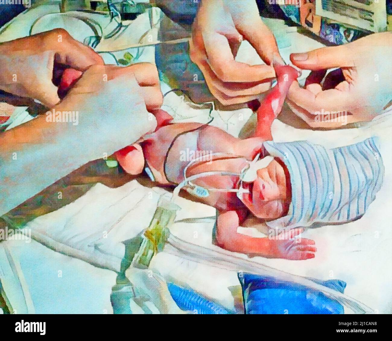A premature baby is seen being treated by the hands of nurses in a neonatal intensive care unit in a digital watercolor painting Stock Photo