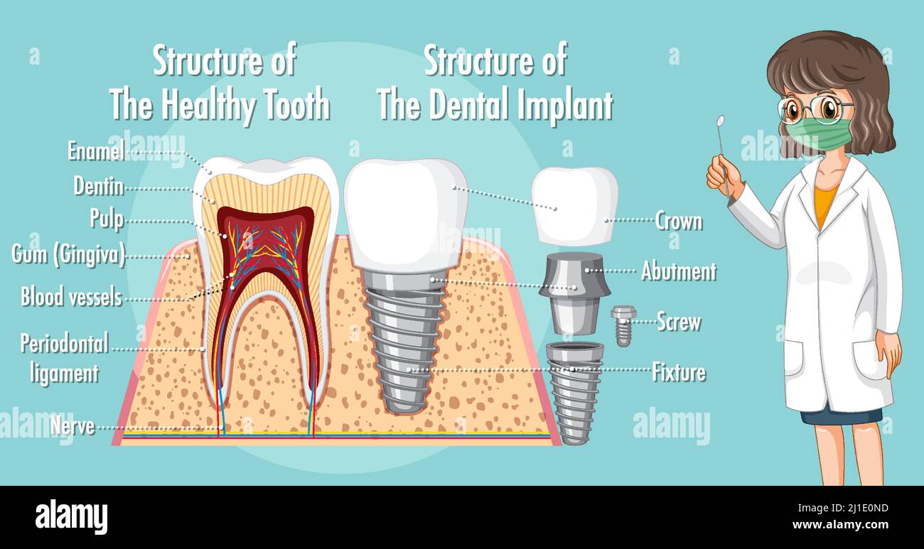 Infographic of human in structure of the dental implant illustration Stock Vector