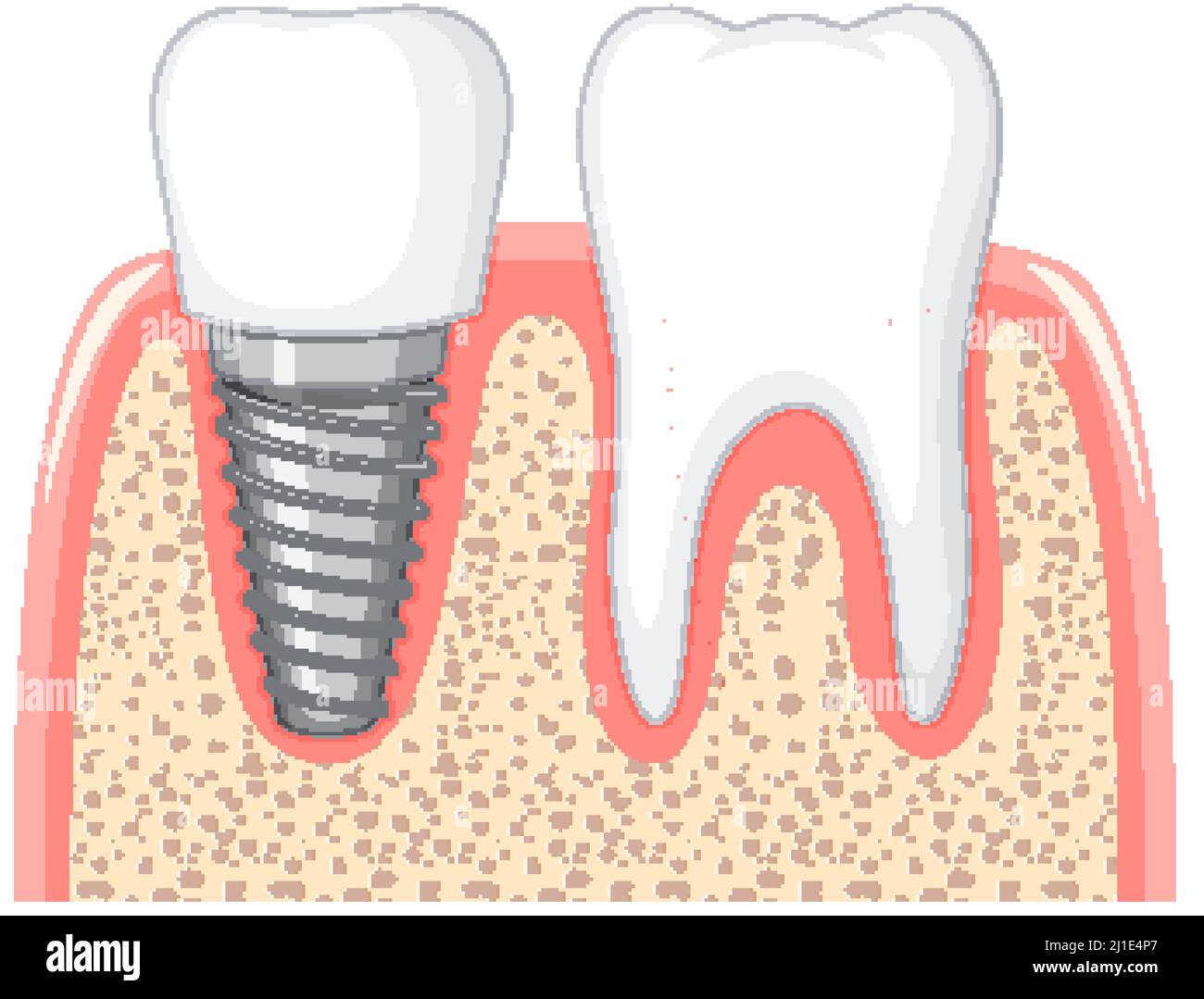 Heathy tooth and dental implant in gum on white background illustration Stock Vector