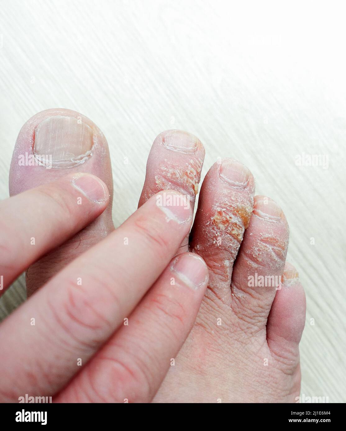 closeup foot skin diseases, callus formation on the fingers, calluses