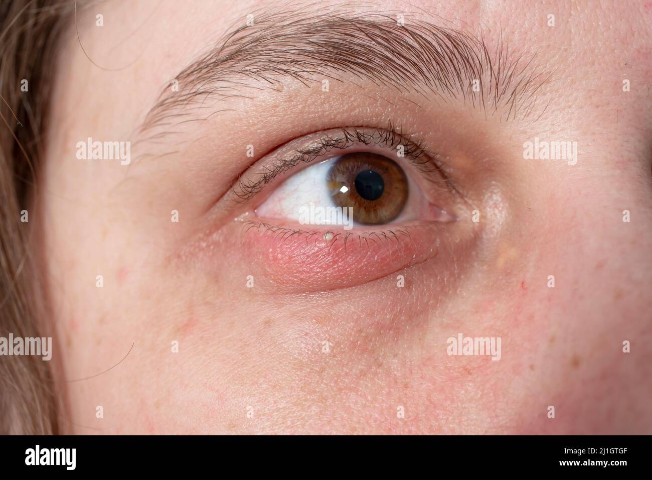 external Chalazion or Hordeolum (Stye), on a Caucasian woman's eyelid Stock Photo