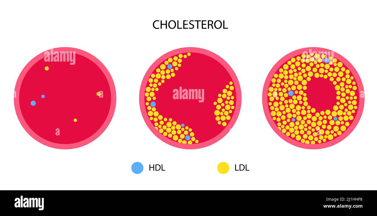 Cholesterol in human blood vessels, illustration Stock Photo Alamy