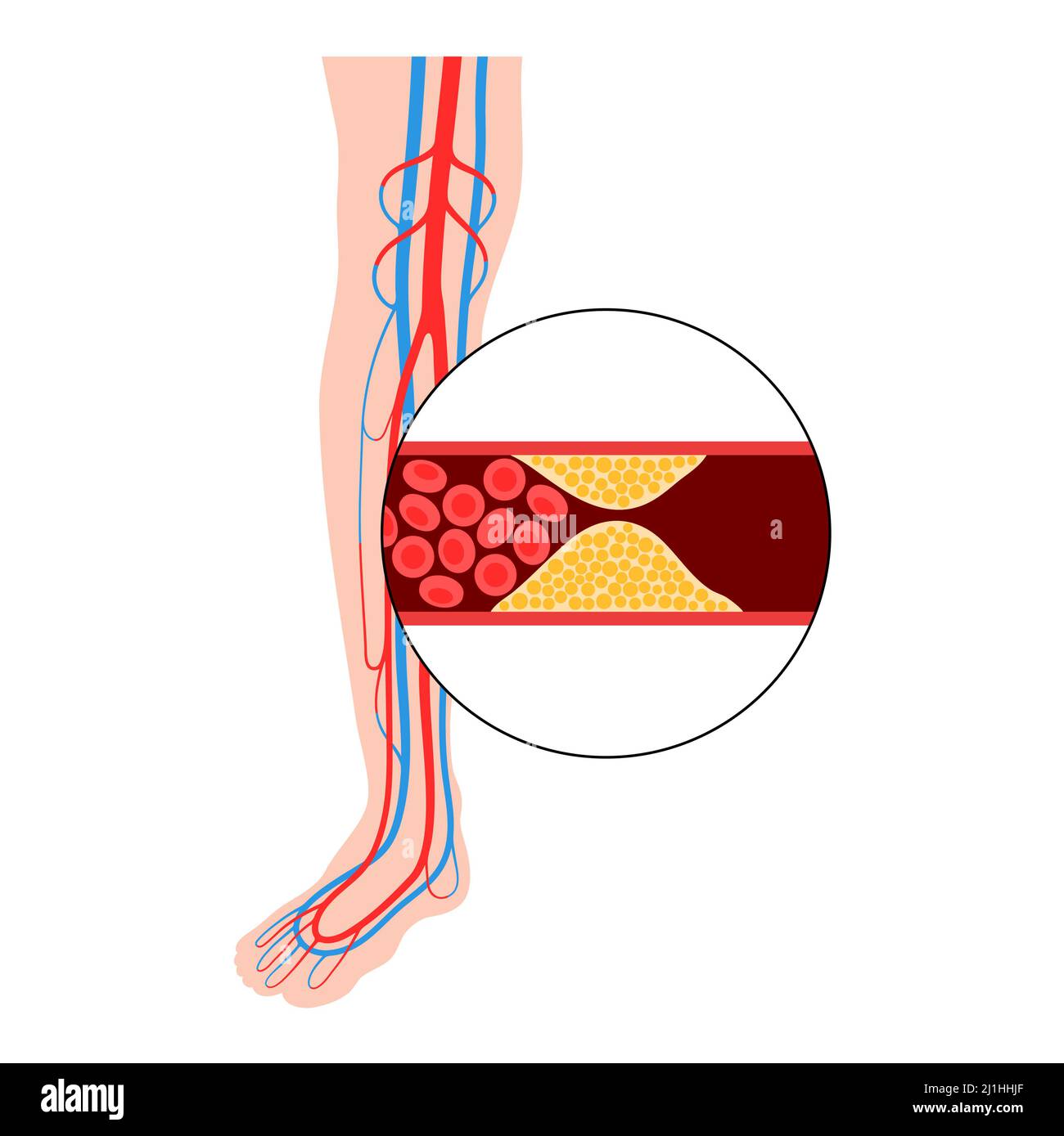 Peripheral artery disease, illustration Stock Photo - Alamy