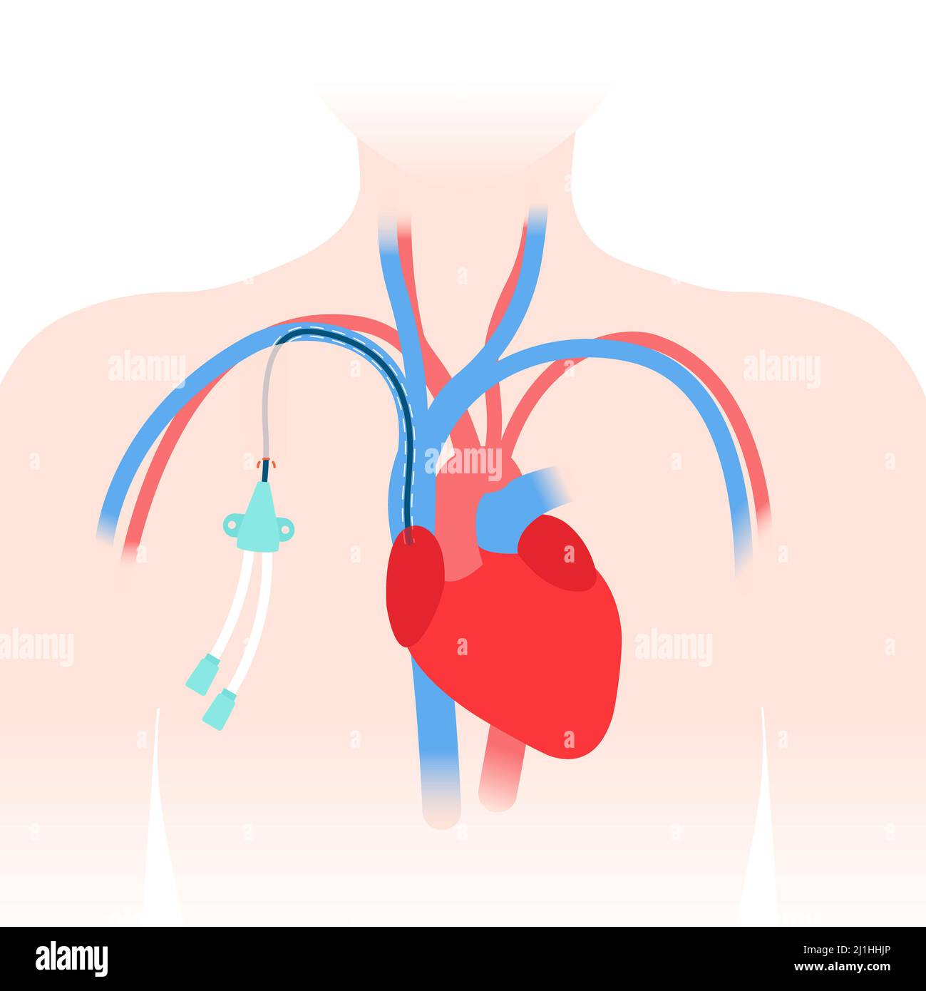Central venous catheter, illustration Stock Photo Alamy