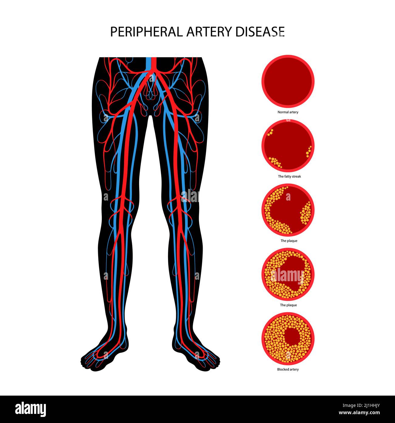 Peripheral artery disease, illustration Stock Photo - Alamy