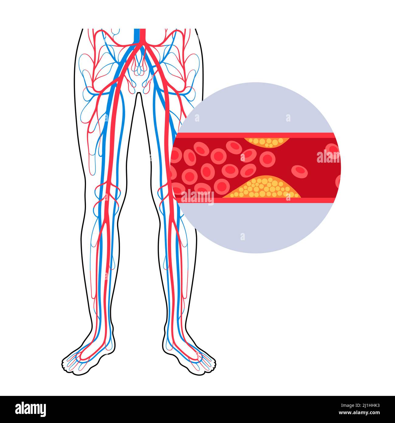 Peripheral artery disease, illustration Stock Photo - Alamy