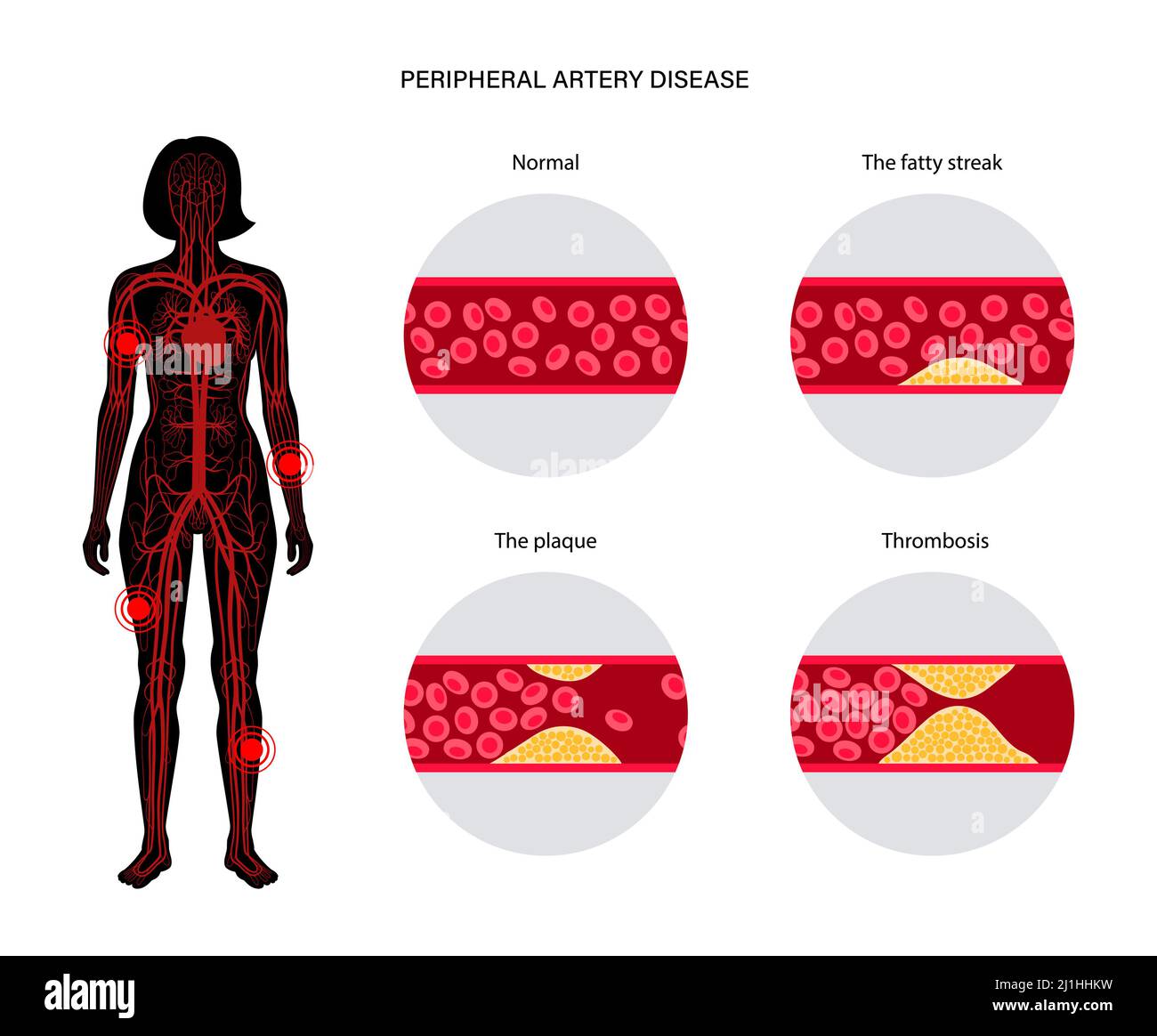 Peripheral artery disease, illustration Stock Photo - Alamy