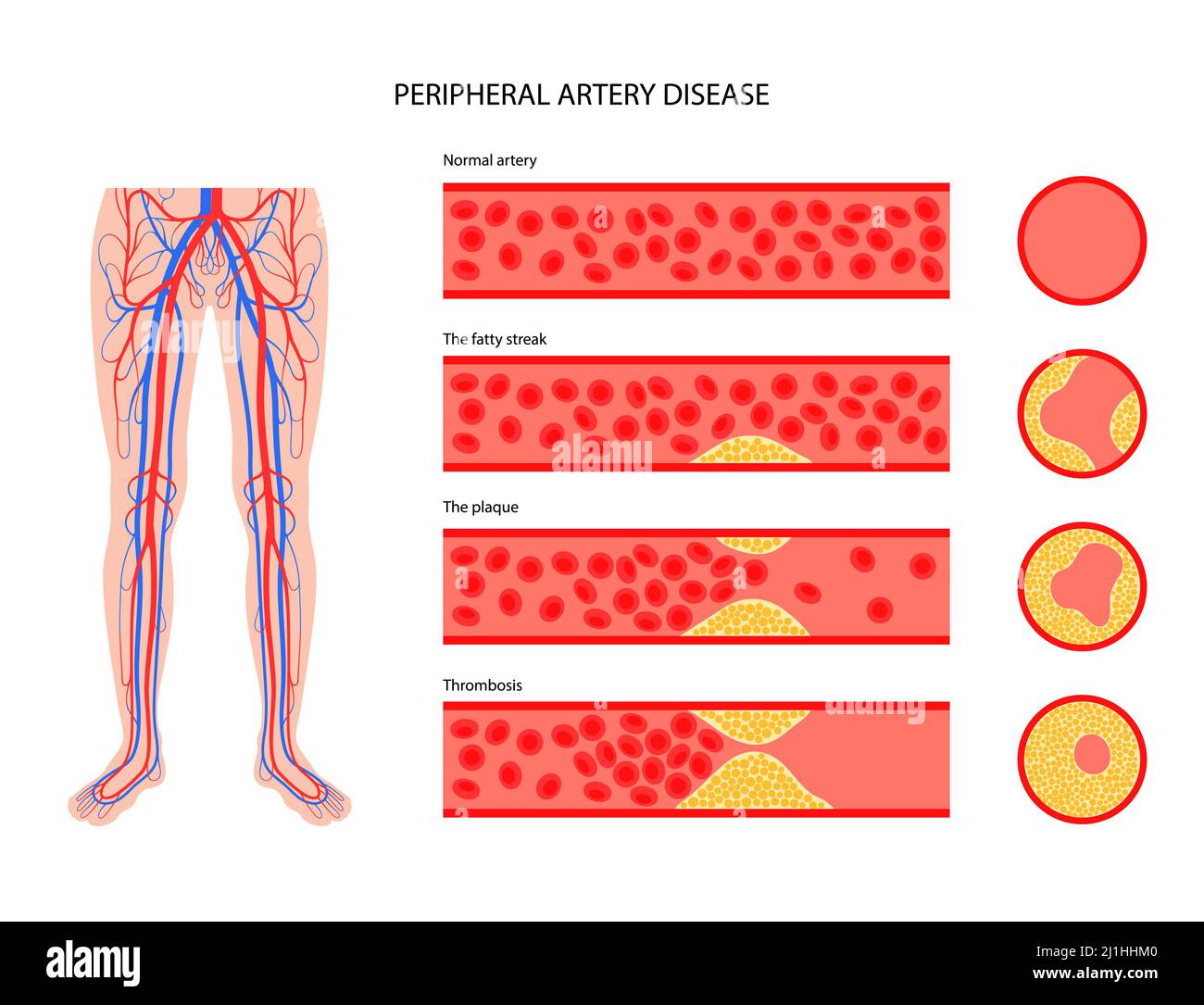 Peripheral artery disease, illustration Stock Photo - Alamy