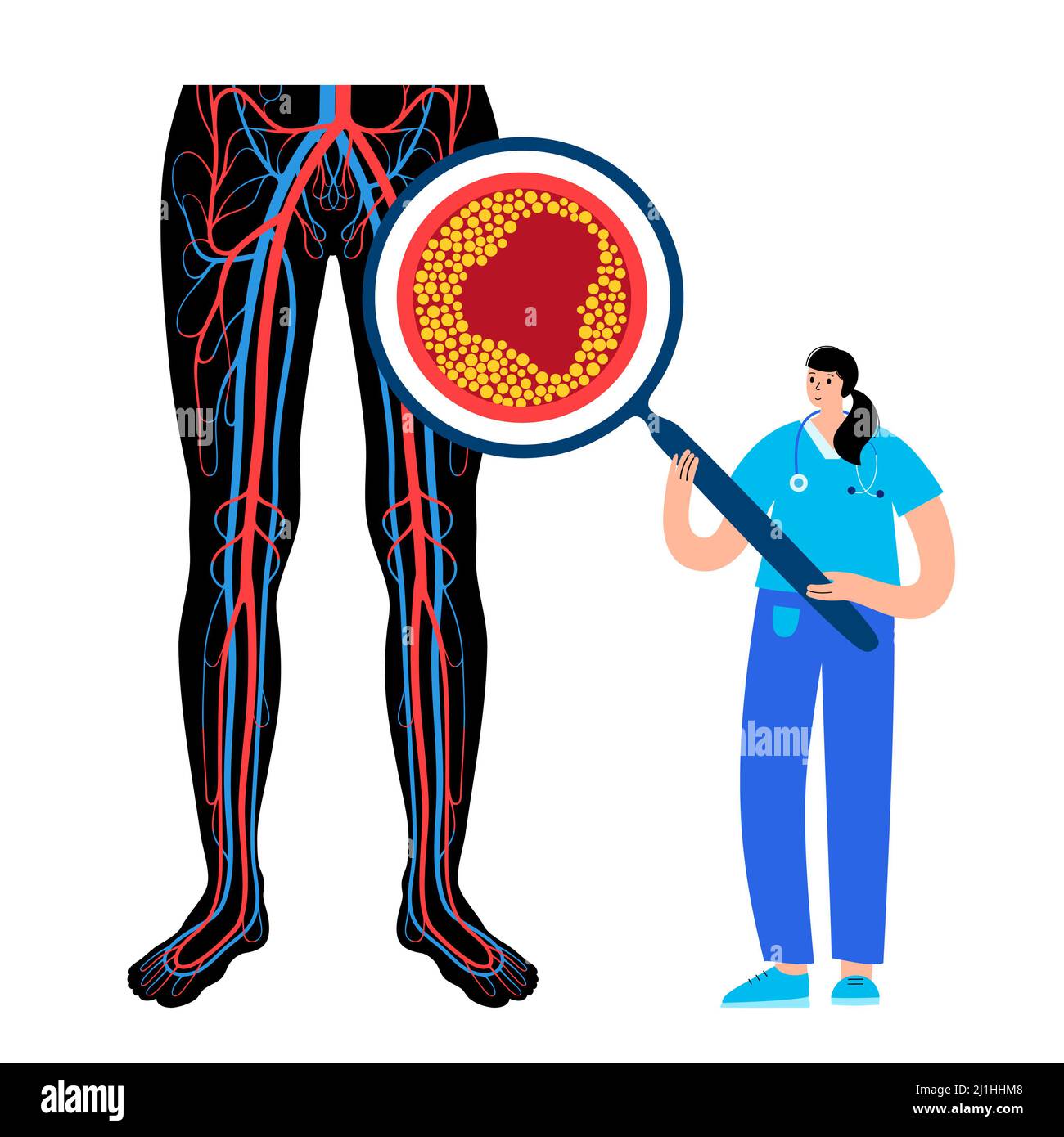 Peripheral artery disease, illustration Stock Photo - Alamy