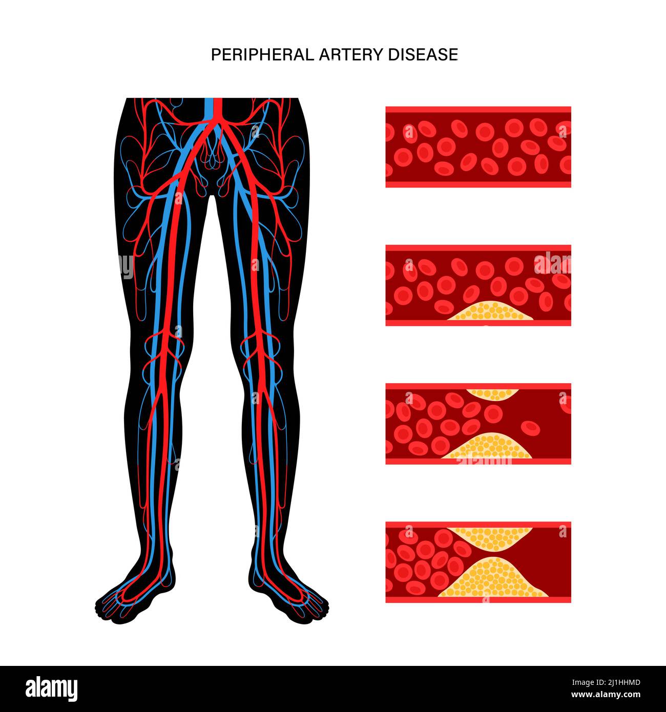 Peripheral artery disease, illustration Stock Photo - Alamy