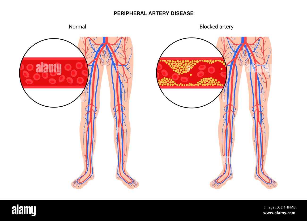 Peripheral artery disease, illustration Stock Photo - Alamy