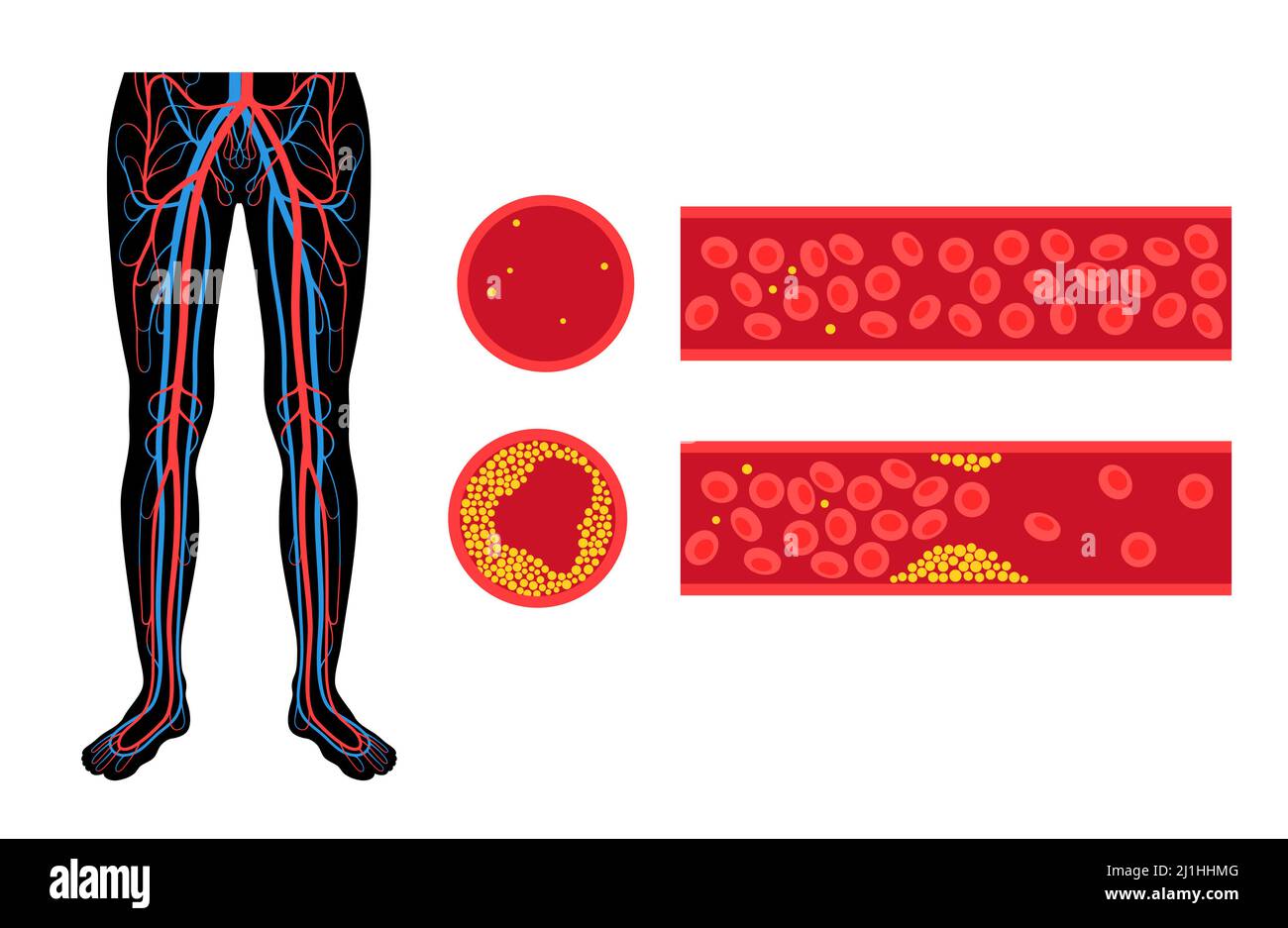 Peripheral artery disease, illustration Stock Photo - Alamy