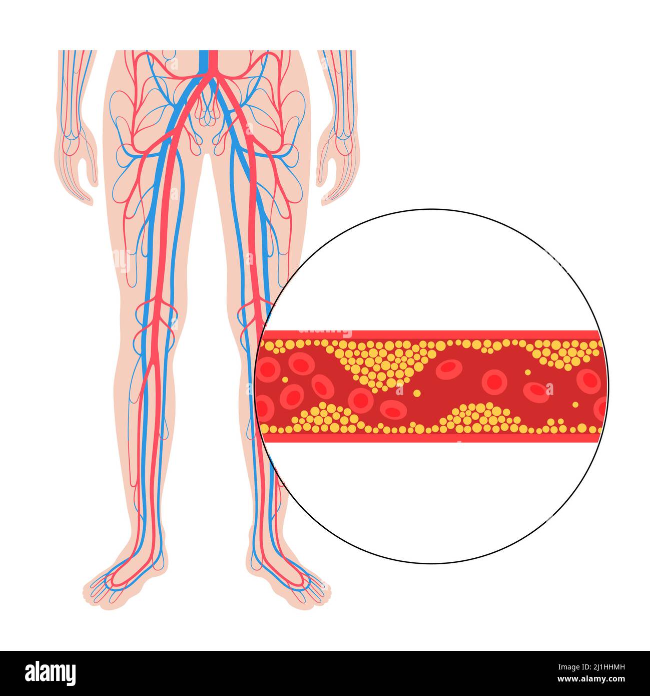 Peripheral artery disease, illustration Stock Photo - Alamy