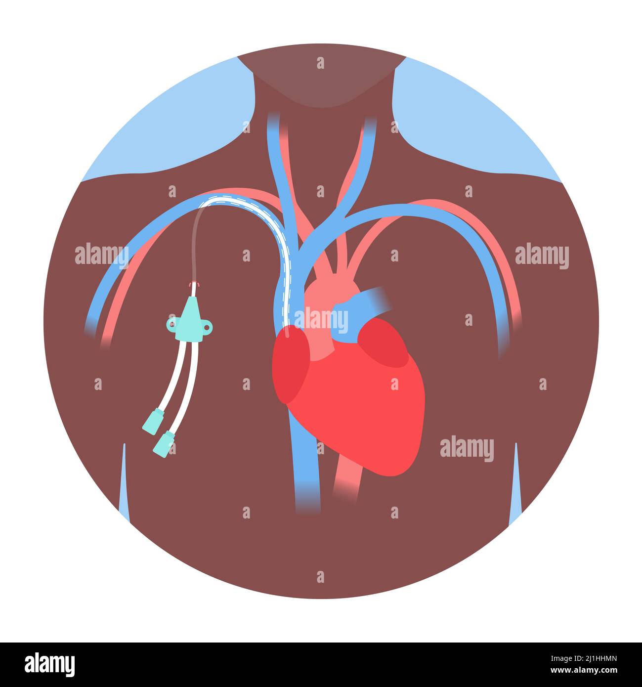 Central venous catheter, illustration Stock Photo Alamy