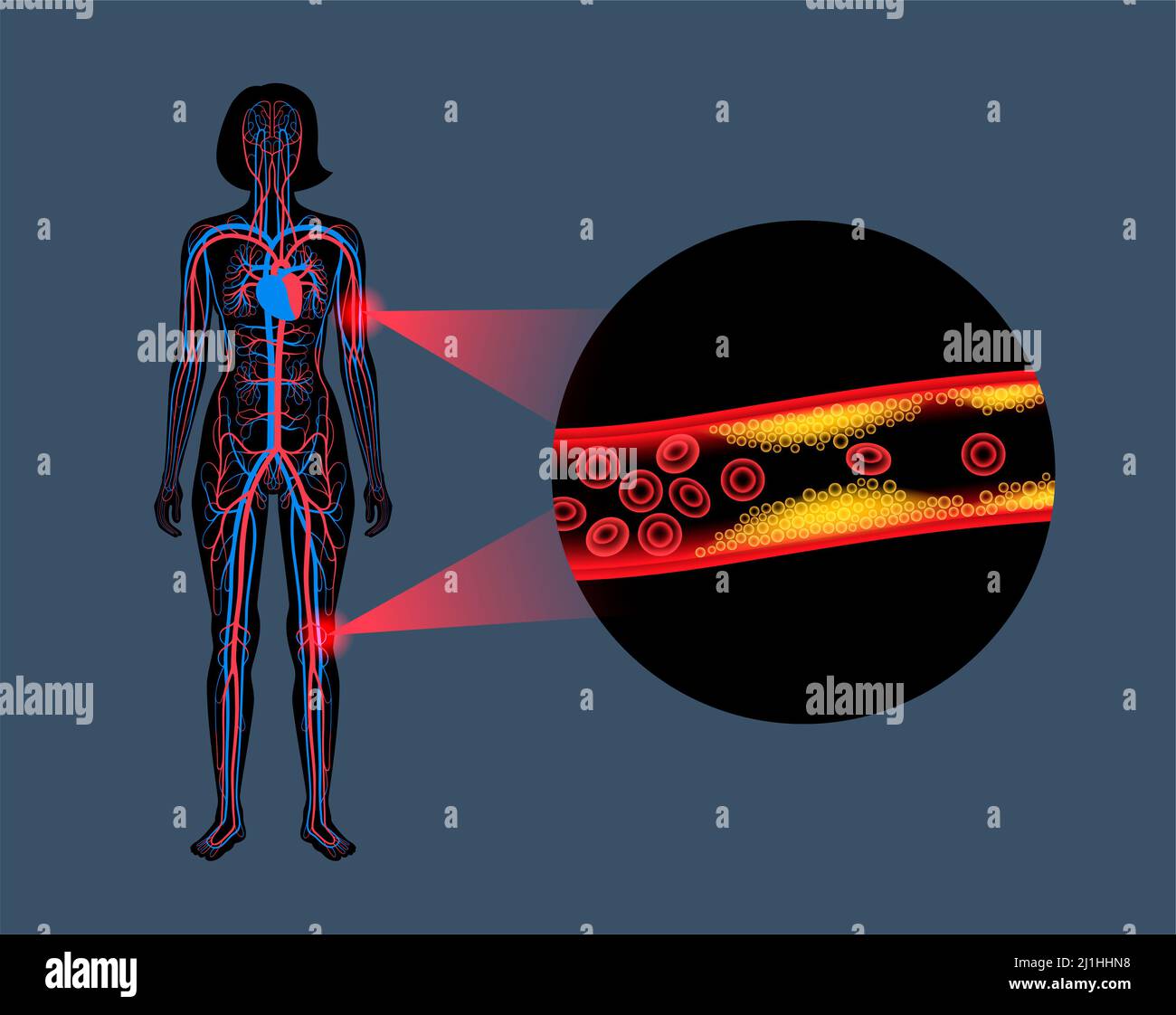 Peripheral artery disease, illustration Stock Photo - Alamy