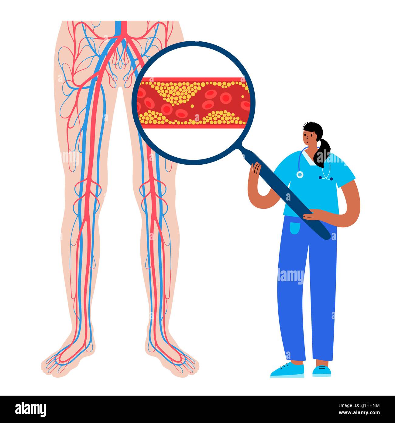 Peripheral artery disease, illustration Stock Photo - Alamy