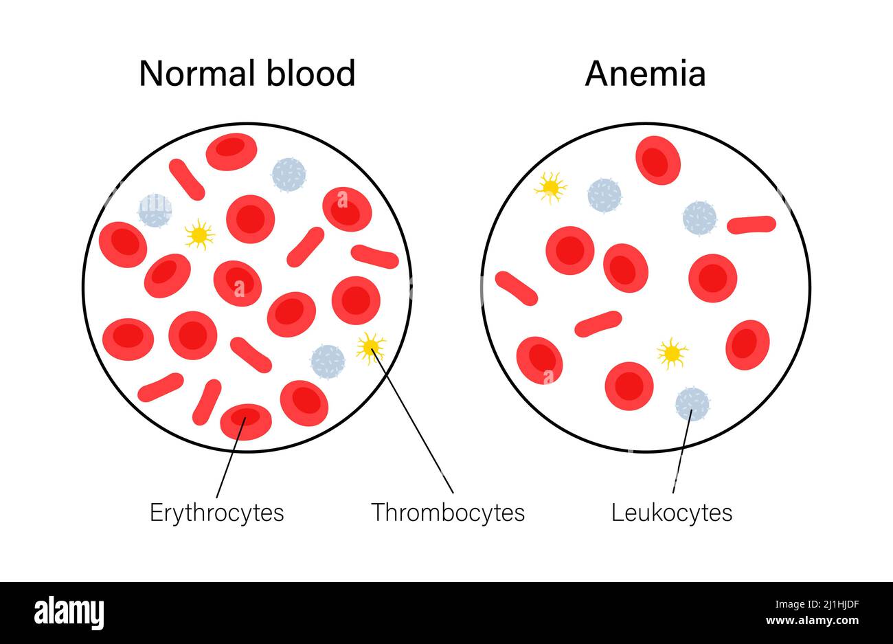 Normal Blood And Anaemic Blood Illustration Stock Photo Alamy