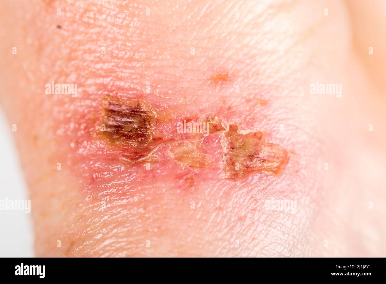chemical burn on the wrist skin with hydroxide sodium acid, by striping