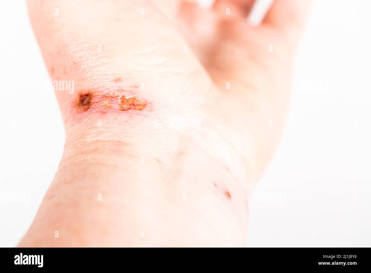 Sodium hydroxide skin hires stock photography and images Alamy