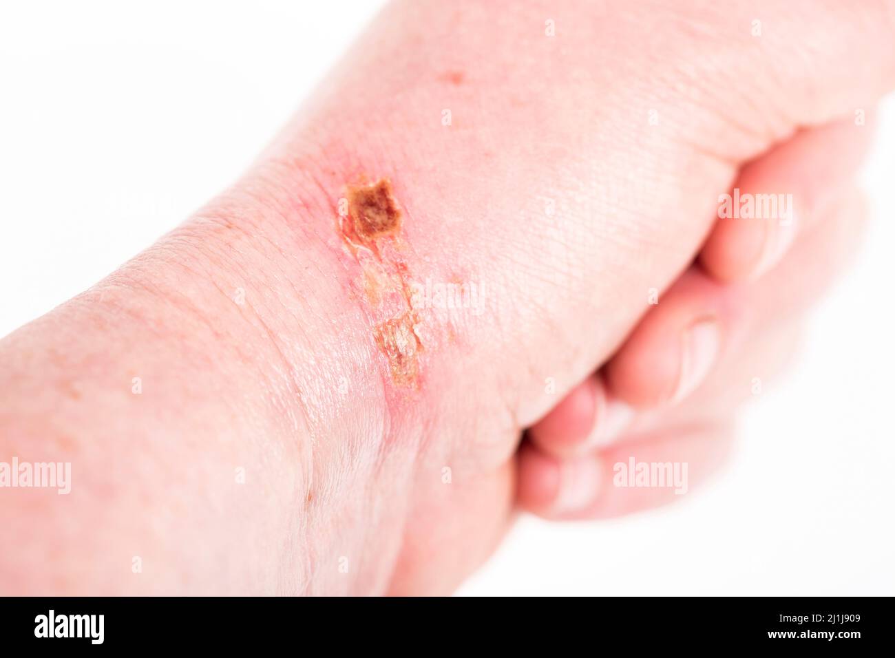 chemical burn on the wrist skin with hydroxide sodium acid, by striping paint from wood. Festering and deep wound. Household accident, because of glov Stock Photo