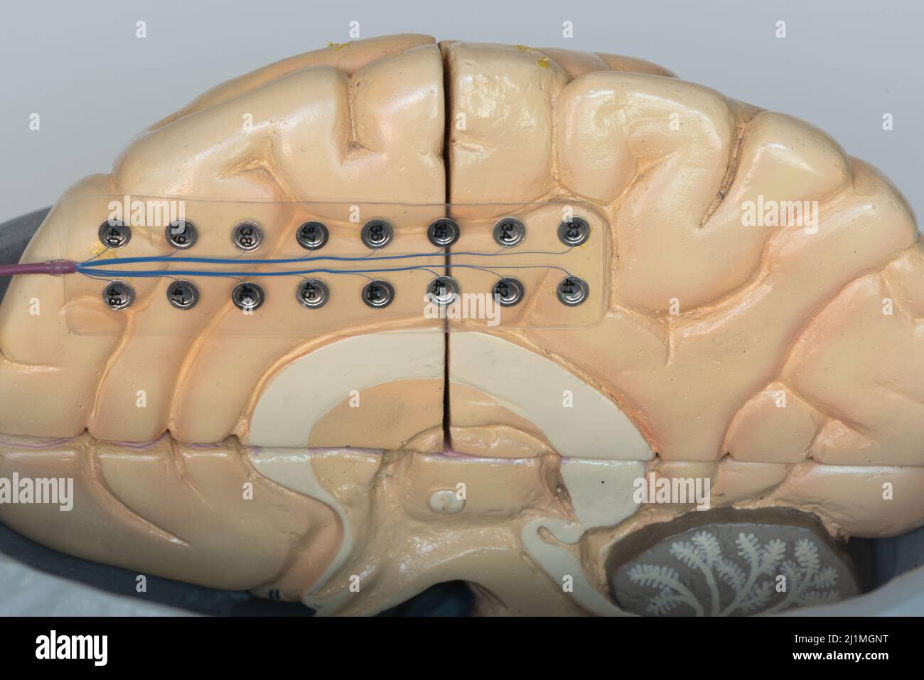 Close-up view of subdural electrode for recording brain waves or electroencephalography on medial surface of cerebral hemisphere. Stock Photo