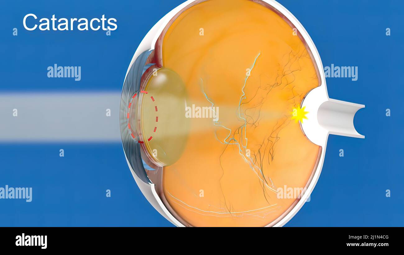 Lens Opacity High Resolution Stock Photography and Images - Alamy