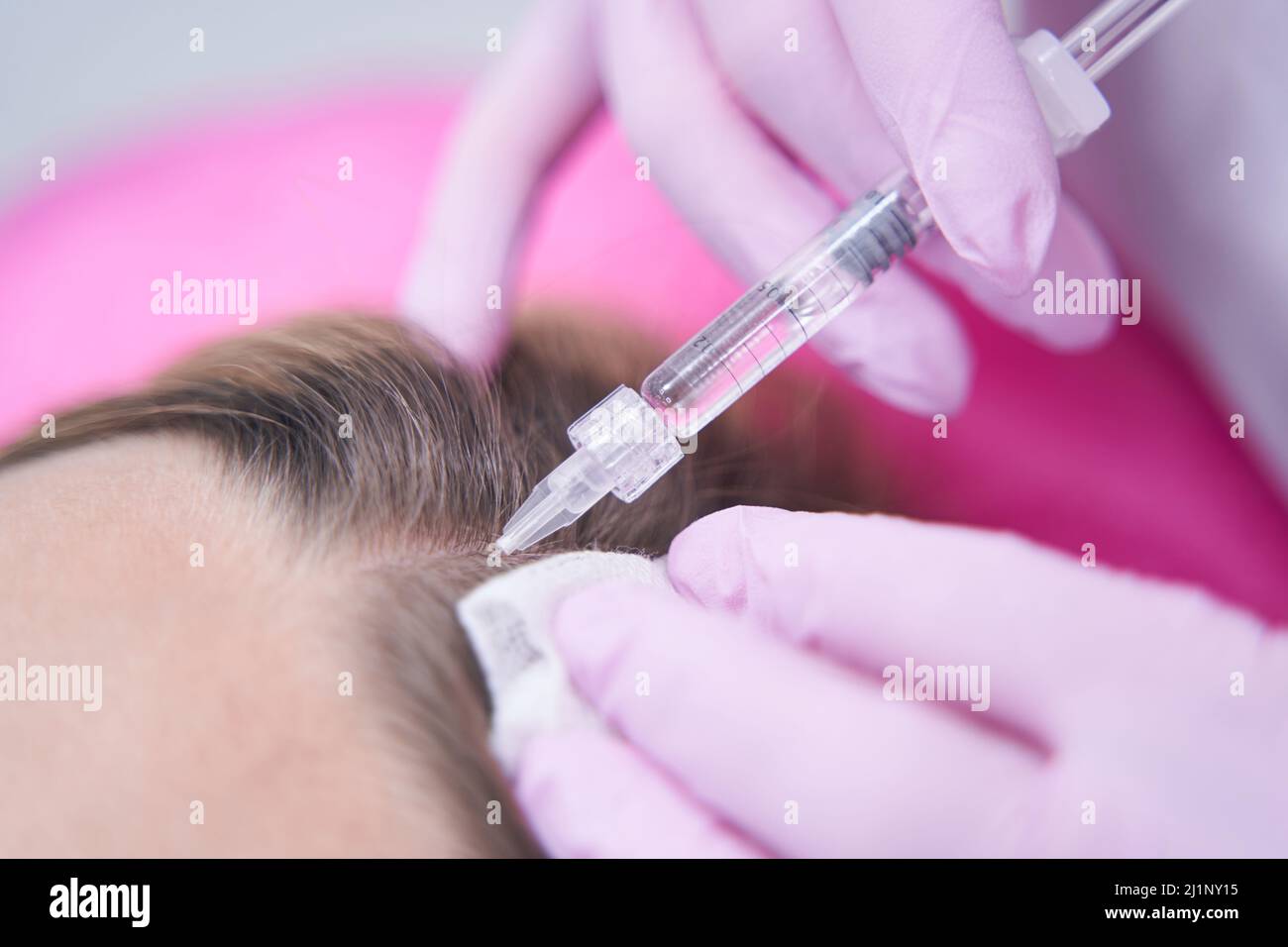 Hair loss injections hi-res stock photography and images - Alamy