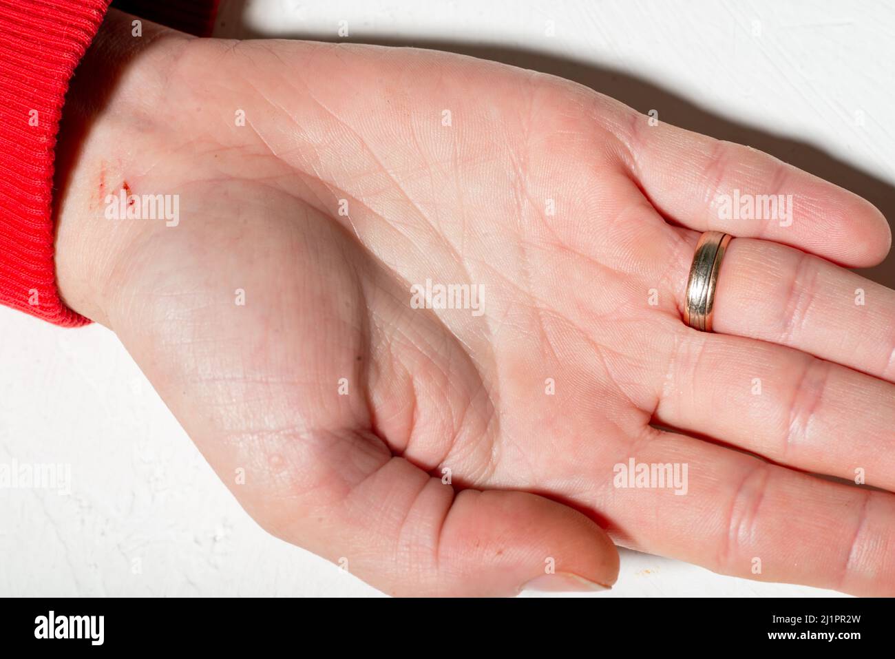 A woman's hand with a small scratch. Woman's hand with a wedding ring ...