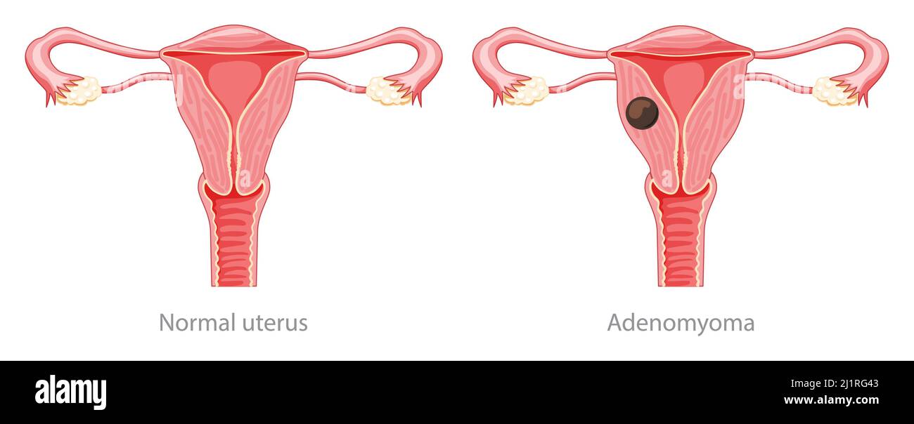 Adenomyoma Adenomyosis Human anatomy Female Sick and normal reproductive system organs. Location scheme Cross section uterus, cervix, ovary, fallopian tube icon. Vector illustration isolated on white Stock Vector