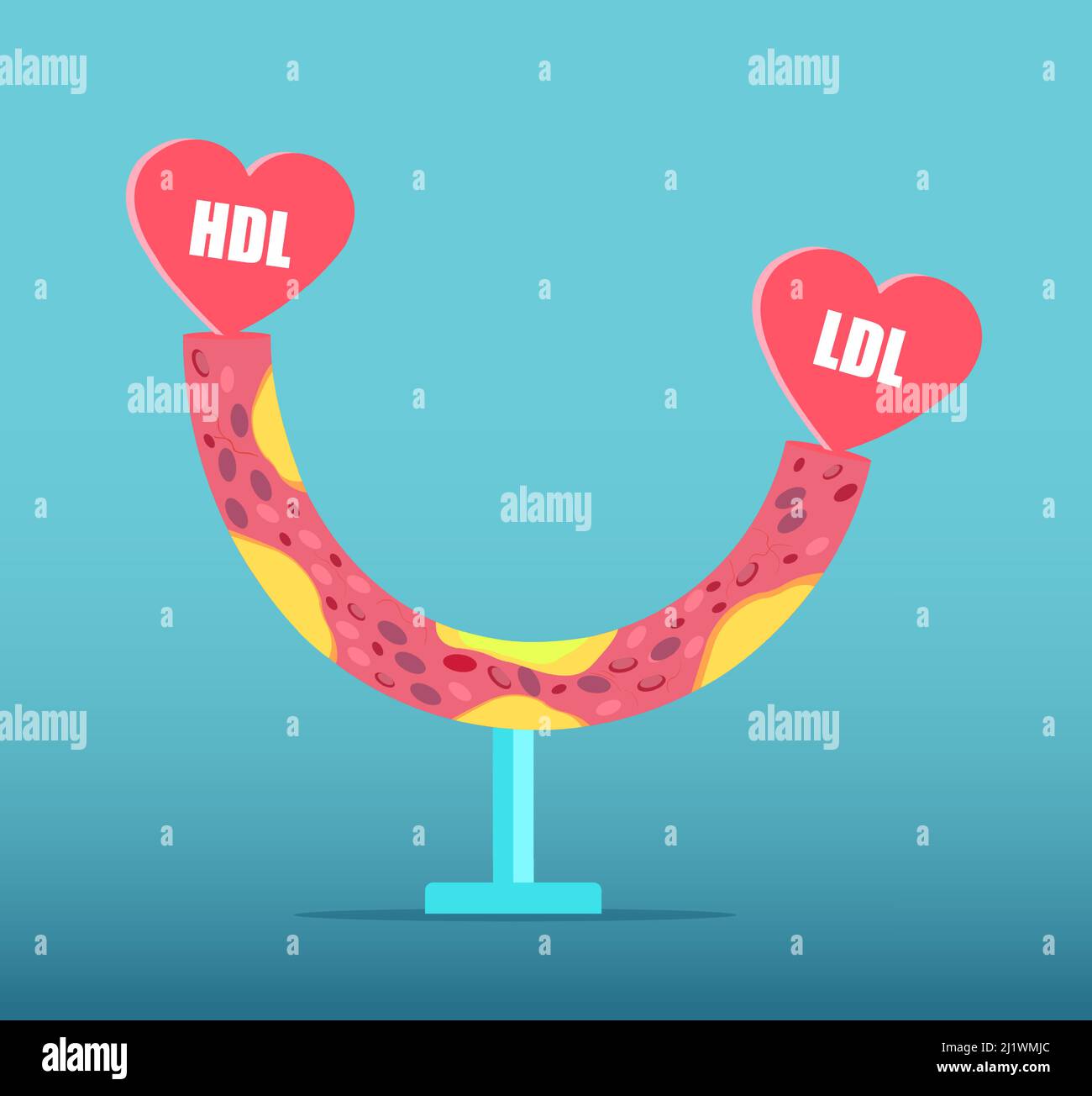 Vector of a blood vessel with atherosclerotic plaques in a patient with HDL and LDL misbalance Stock Vector
