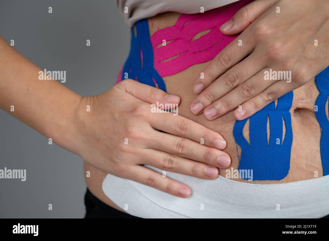 Physiotherapy treatment of diastasis with kinesio tapes concept. Woman