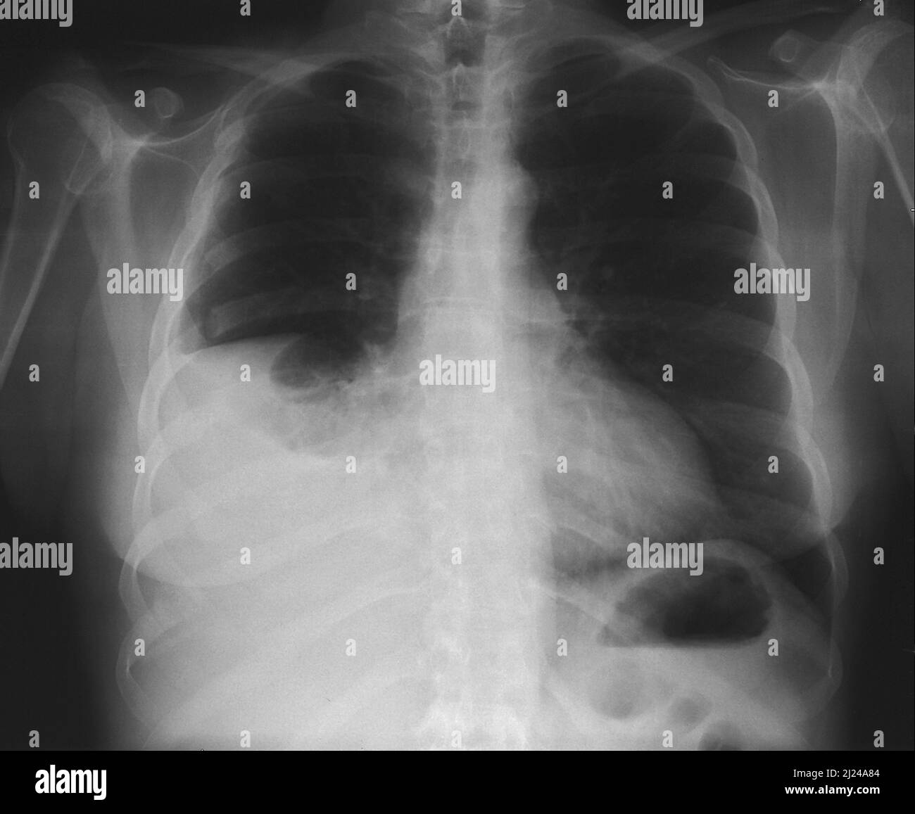 Fractured ribs and pleural effusion, Xray Stock Photo Alamy