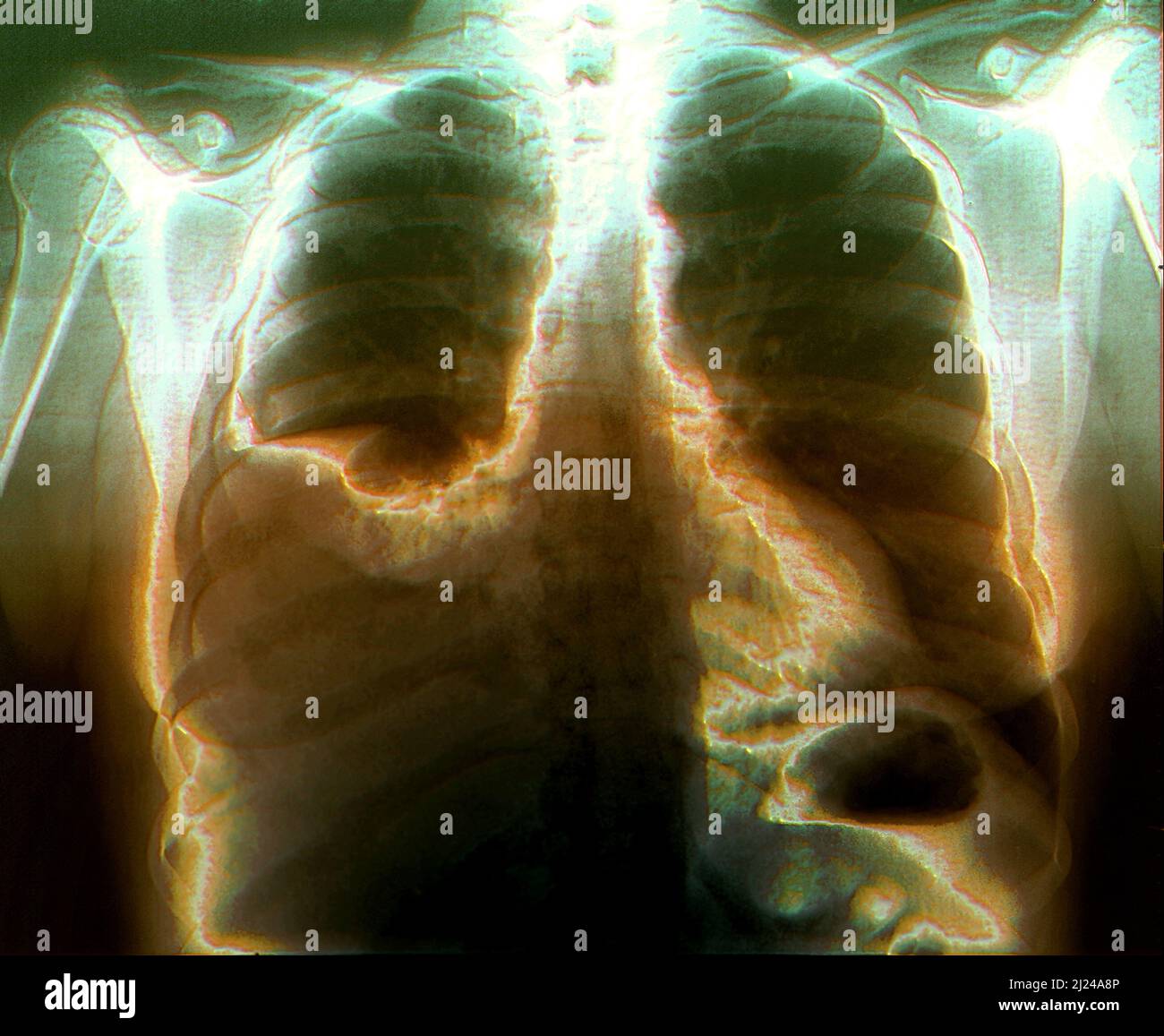 Fractured ribs and pleural effusion, Xray Stock Photo Alamy
