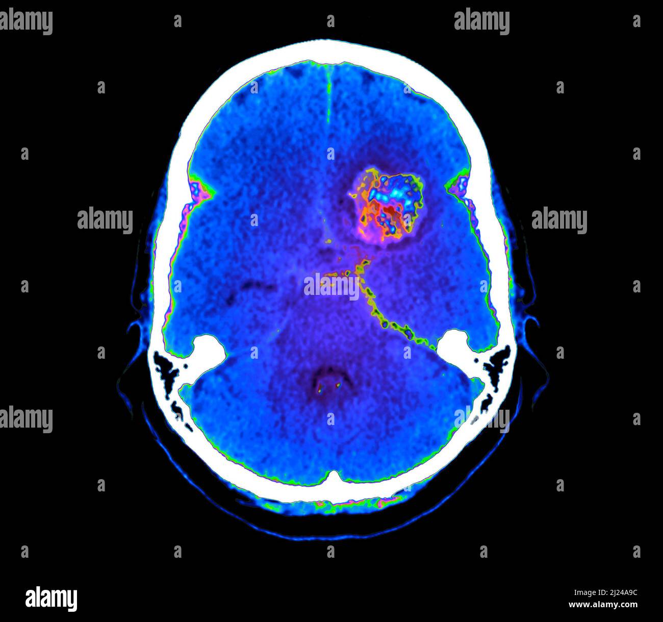 Subarachnoid Haemorrhage CT Scan Stock Photo Alamy subarachnoid-haemorrhage-ct-scan-stock-photo-alamy
