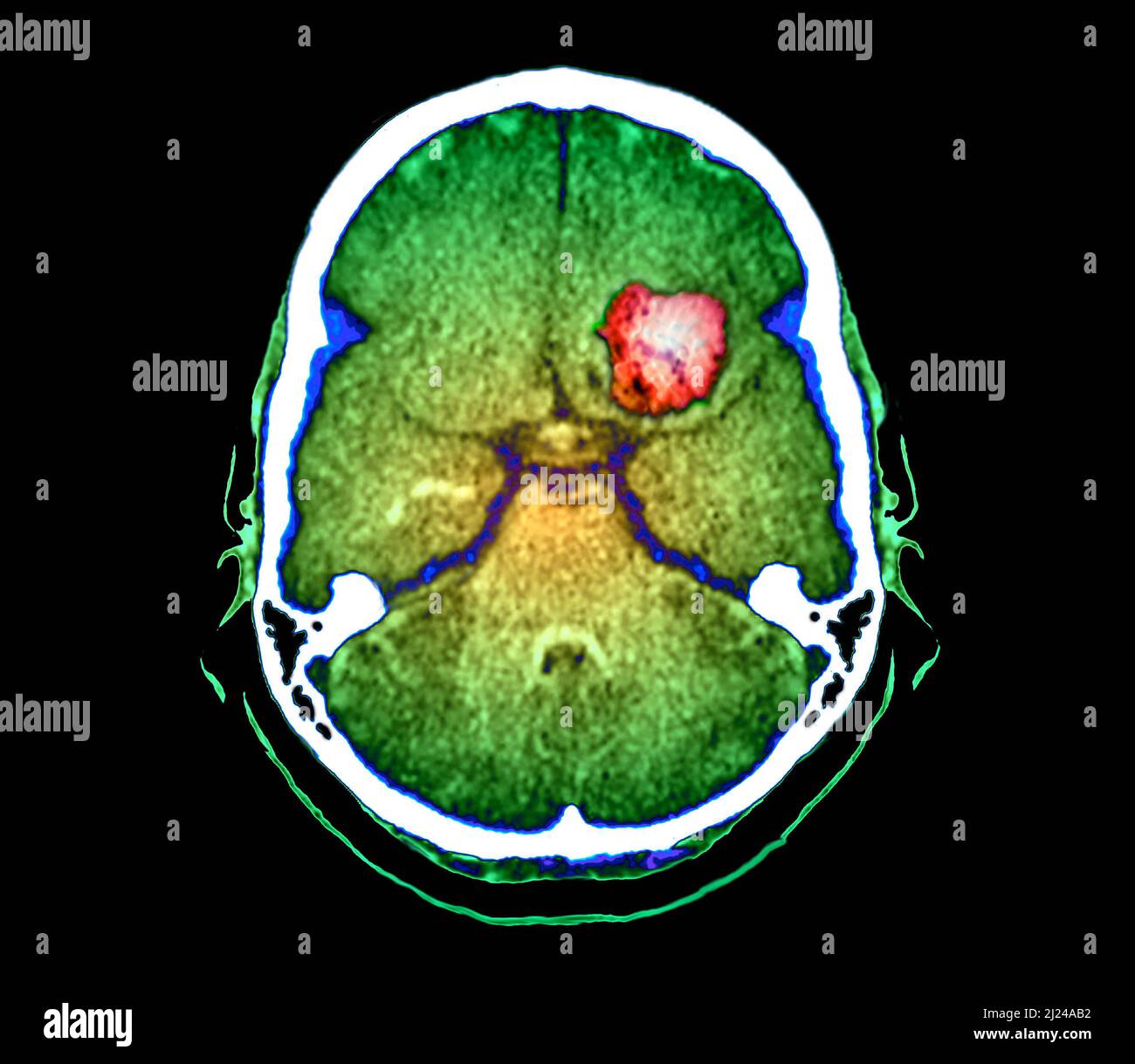 Subarachnoid Haemorrhage CT Scan Stock Photo Alamy subarachnoid-haemorrhage-ct-scan-stock-photo-alamy