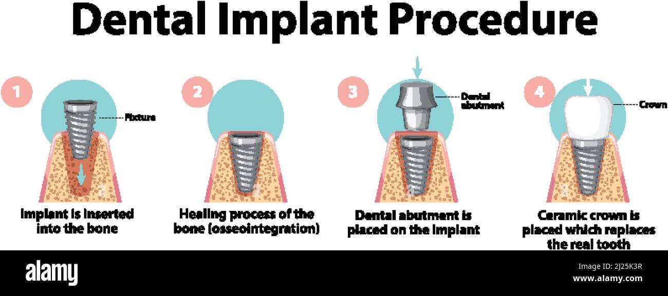 Infographic of human in dental implant procedure illustration Stock