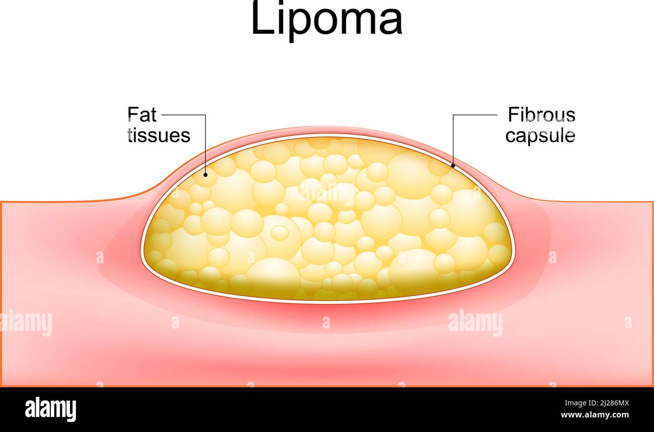 Lipoma. adipose tumors located into the subcutaneous tissues in the skin. Cross section of a human skin. Vector illustration. Stock Vector