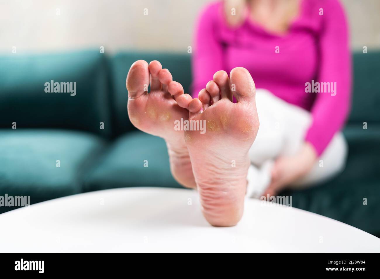 Close up of woman legs with callus on it. Feet with corn caused of heels. Need of pedicure  Stock Photo