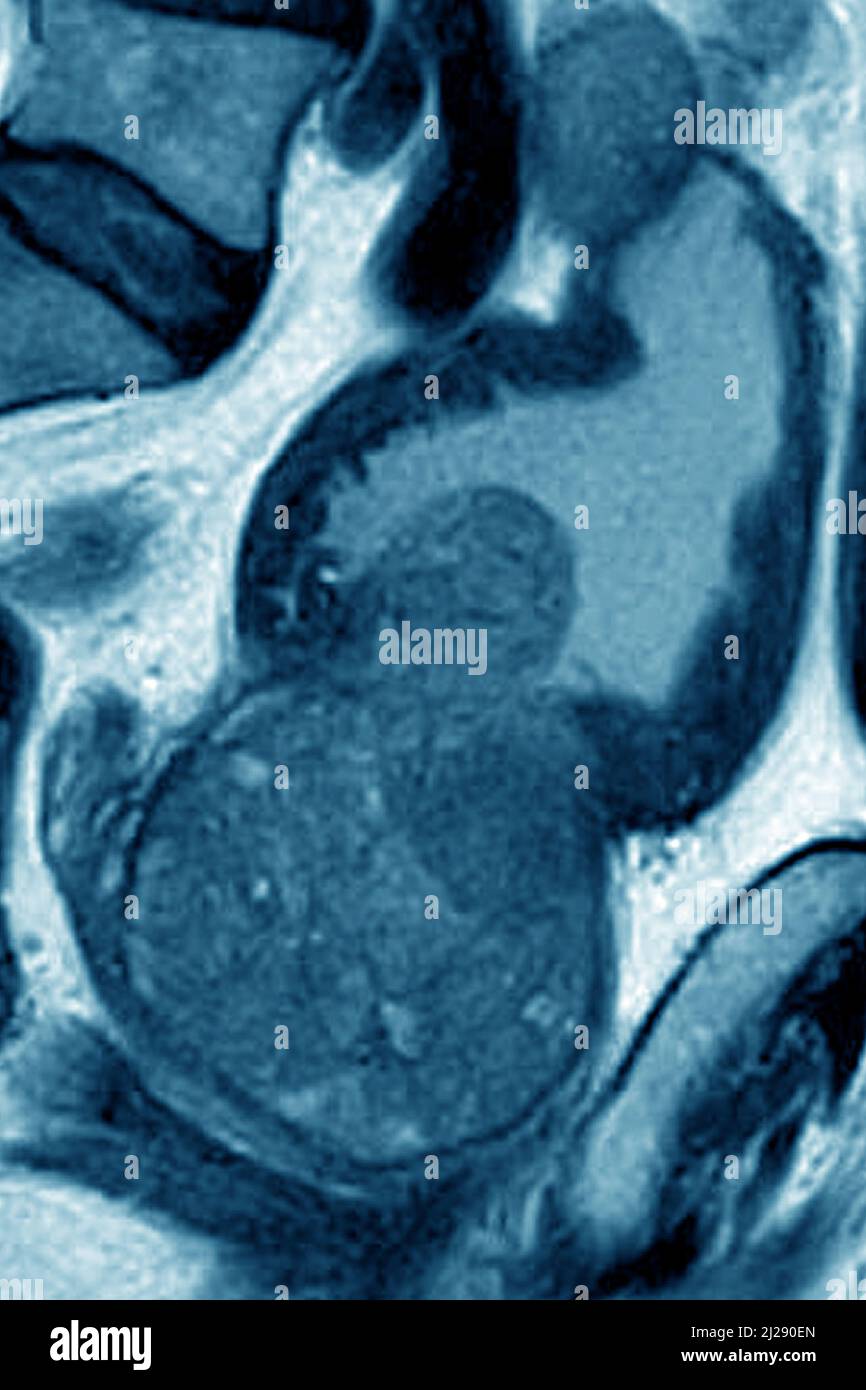 Prostatic adenoma Stock Photo