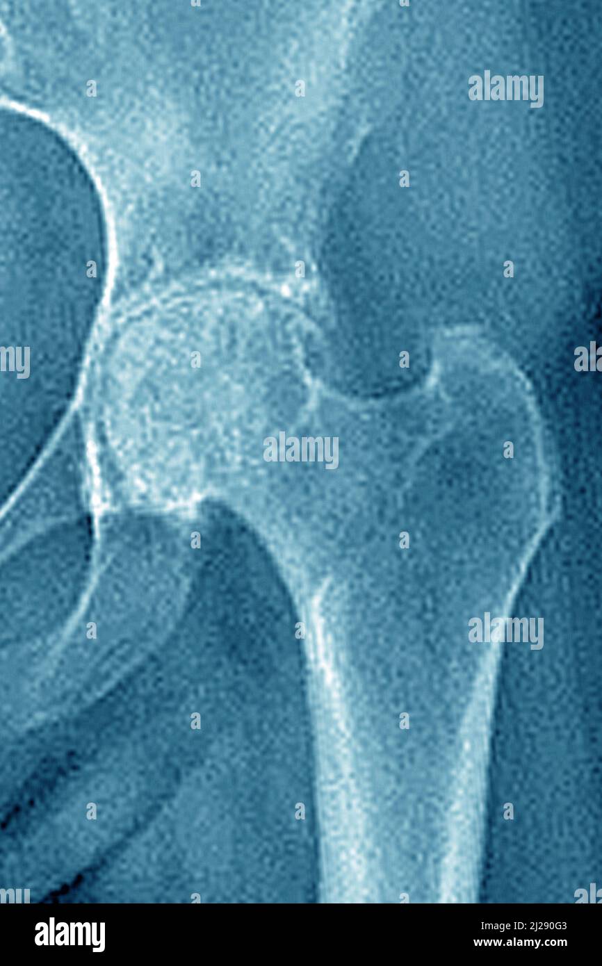 Osteoarthritis of the hip Stock Photo