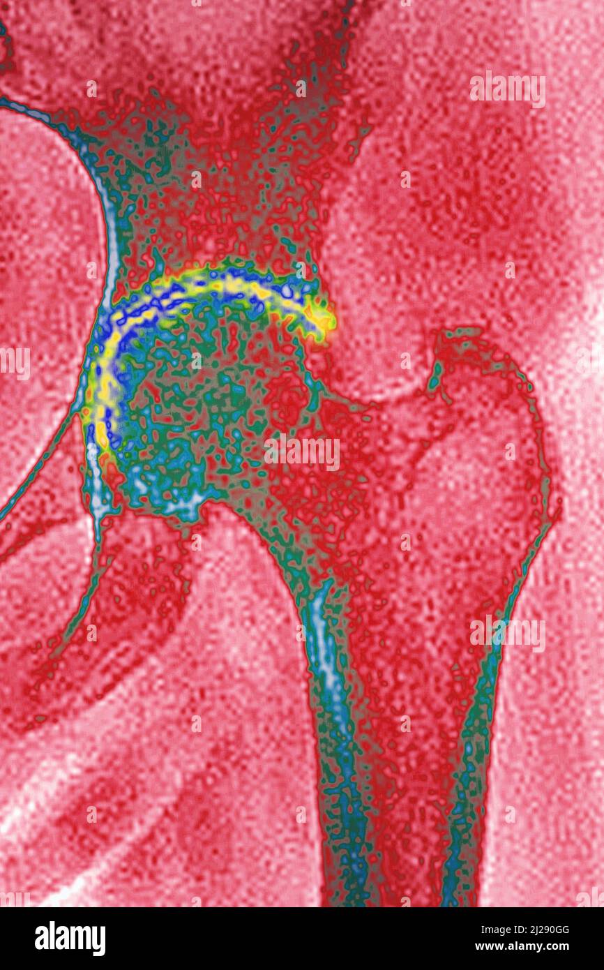 Osteoarthritis of the hip Stock Photo