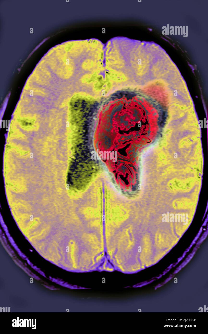 Hemorrhagic stroke (stroke through a ruptured blood vessel). Cerebral
