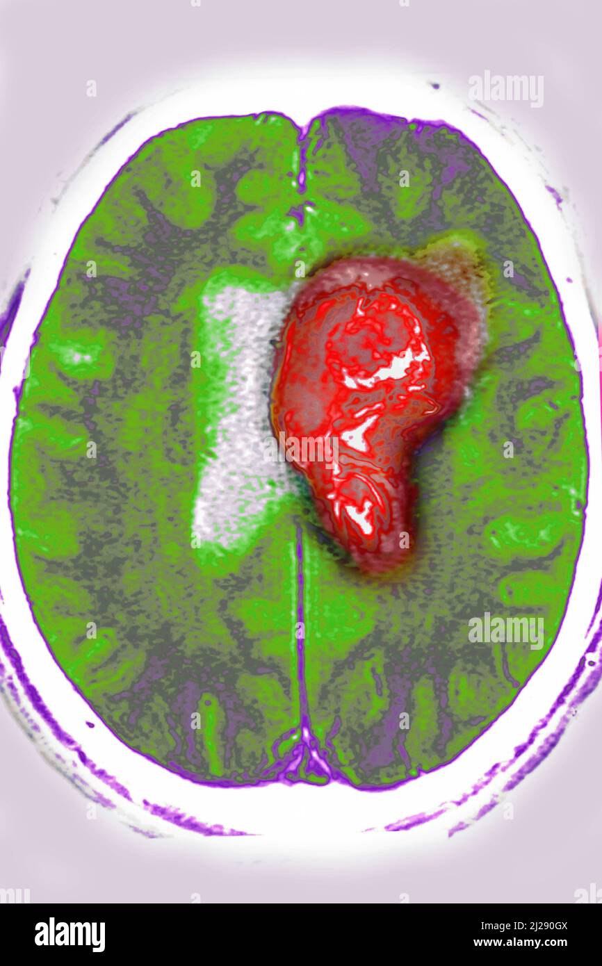 Human brain scan mri hi-res stock photography and images - Alamy