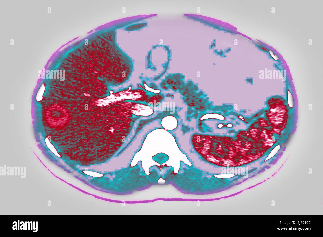 Lymphoreticulosis Stock Photo